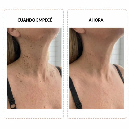 Deja la batalla diaria con tus verrugas y elimínalas sin tratamientos costosos ni dolorosos con Keralis™